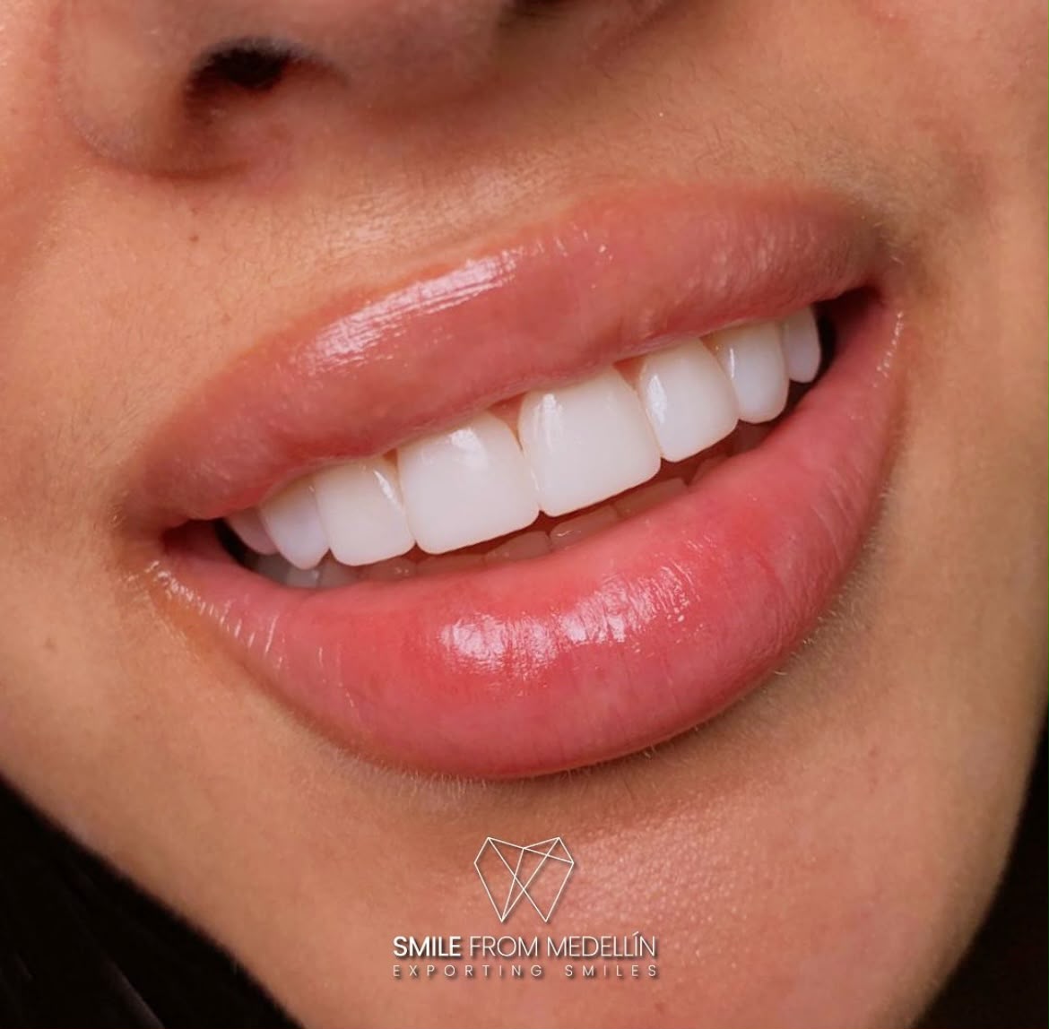 Completed porcelain veneer smile makeover at a Medellín dental clinic