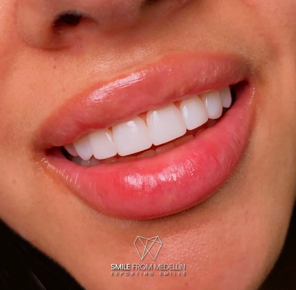 Completed smile makeover with porcelain veneers in Medellín