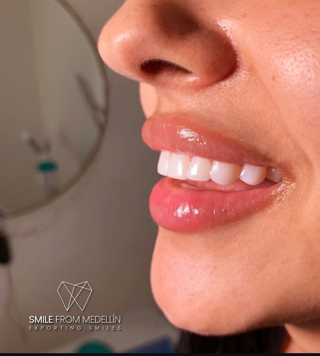 Porcelain veneers in Medellín, side view of the smile design