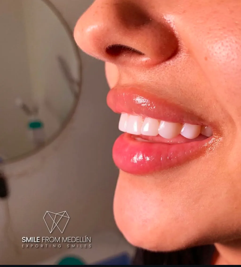 Smile makeover in Colombia, side view of the final result