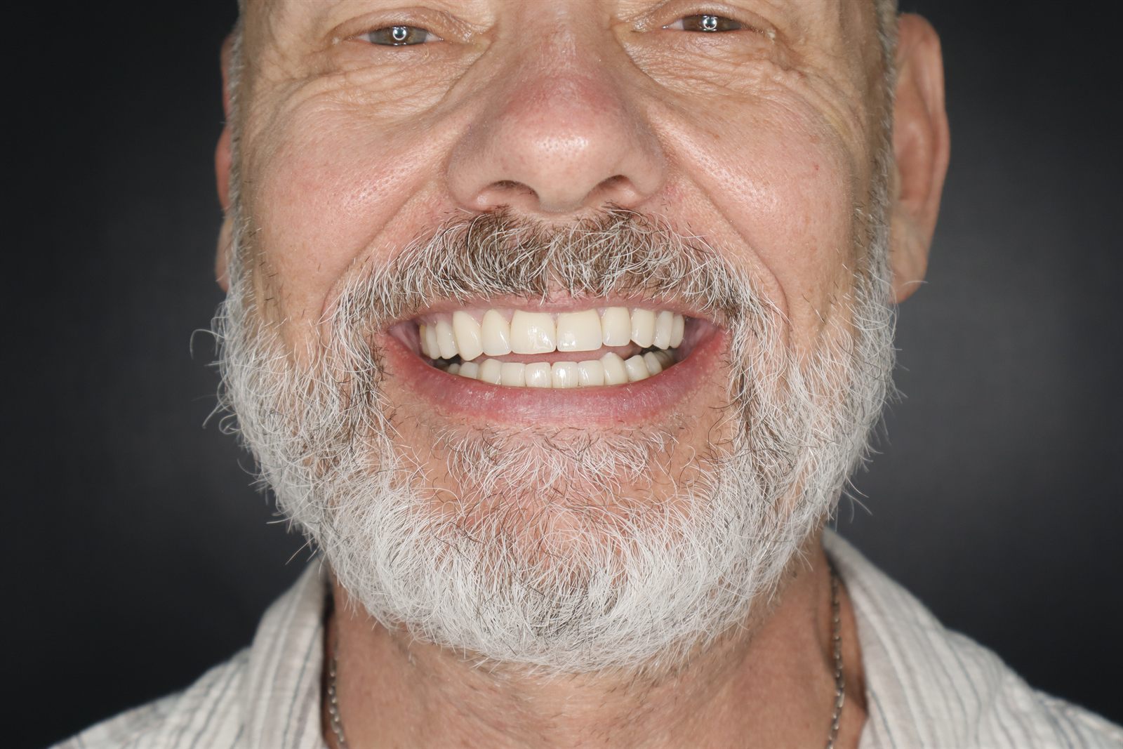 Real smile makeover result at Smile From Medellín — Case 1