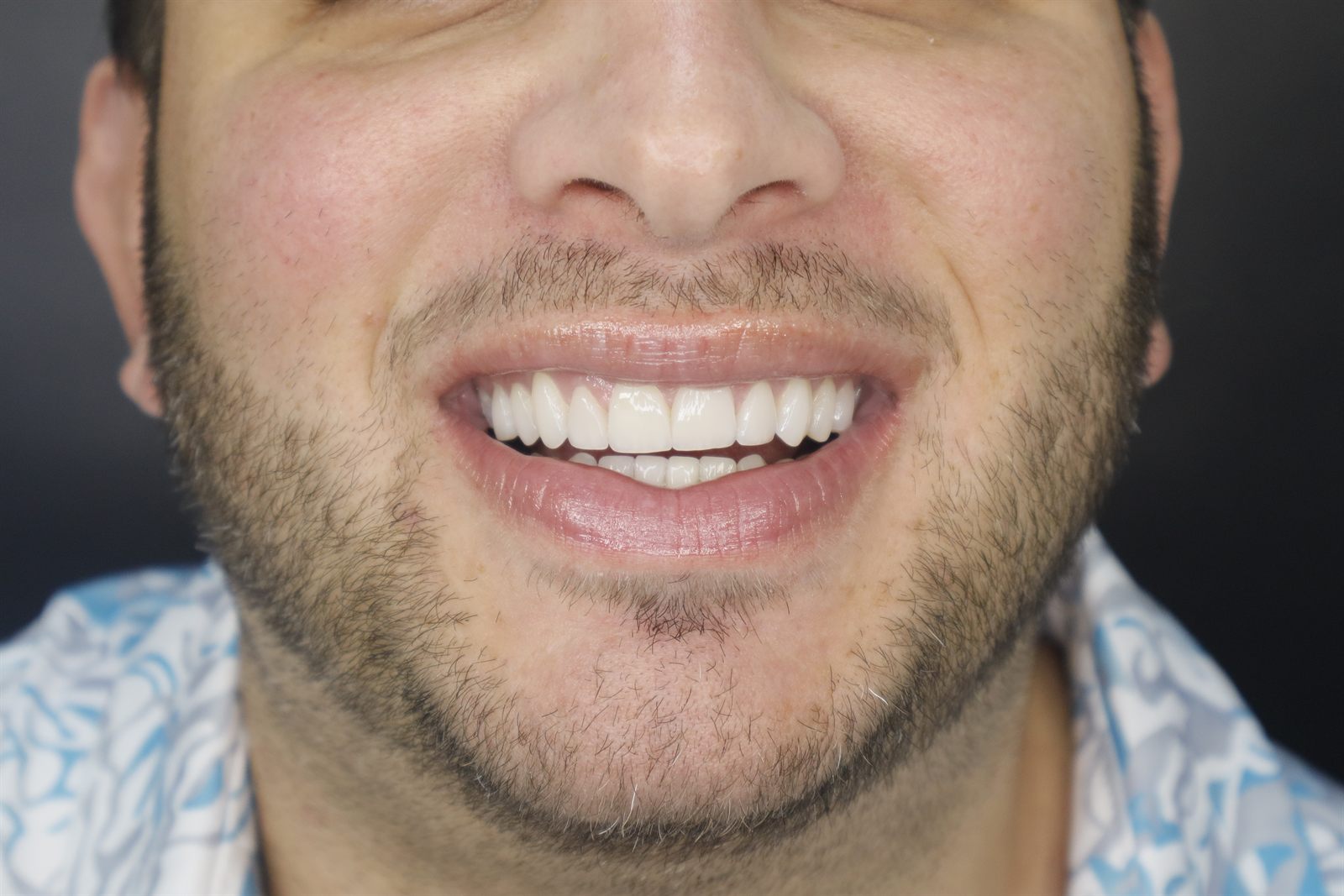 Resultado real después del diseño de sonrisa en Smile From Medellín