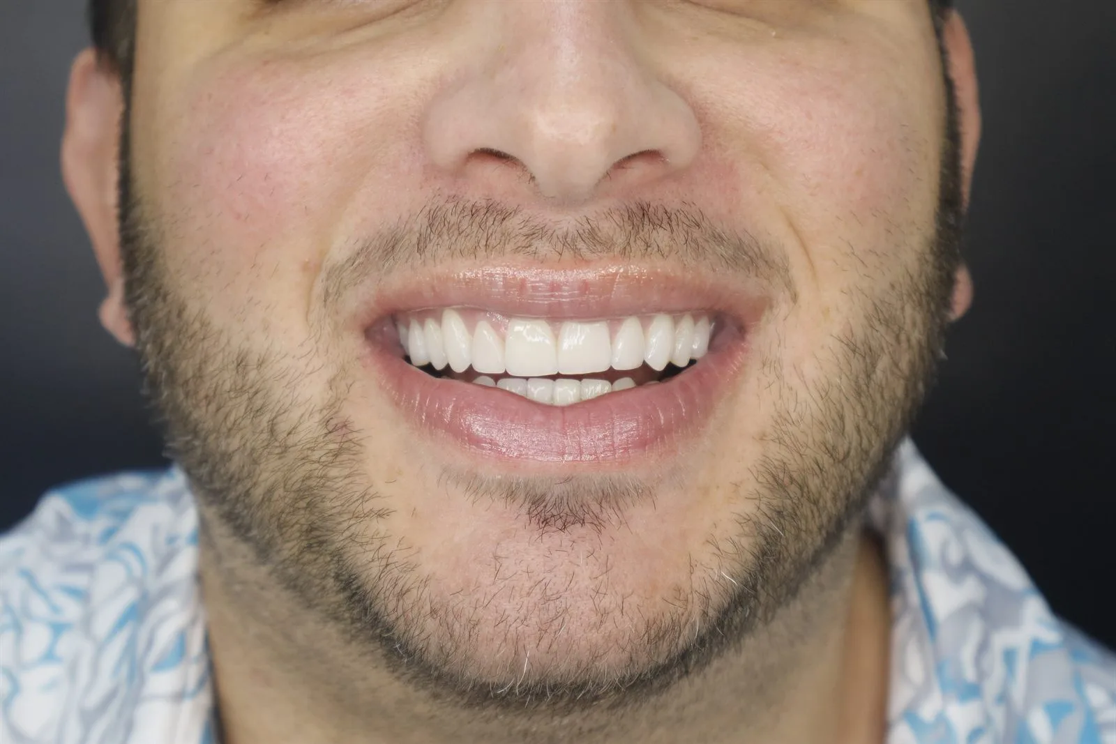 Resultado real después de las carillas dentales en Medellín