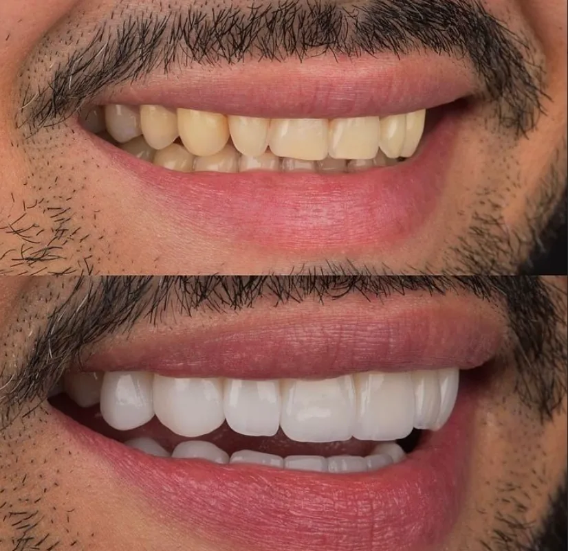 Veneers and whitening combined in a smile makeover in Medellín