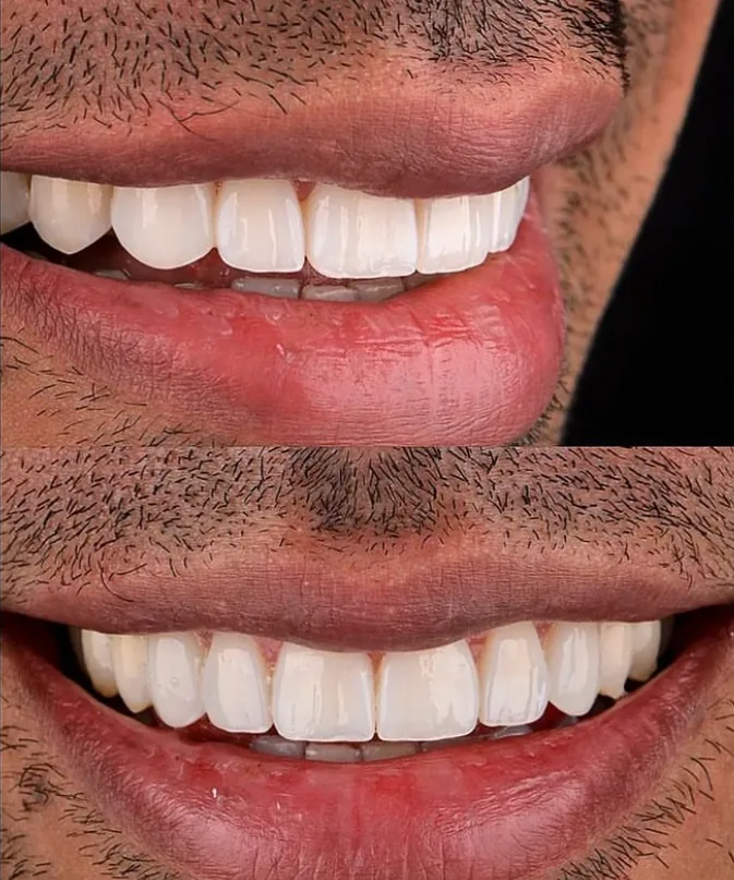 Front view of a smile transformation at Smile From Medellín