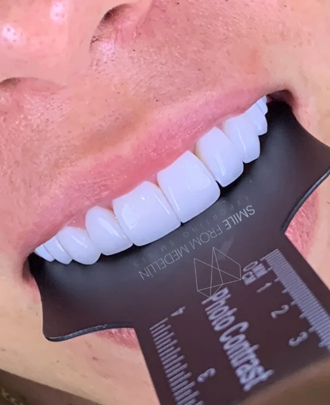 Veneer shade selection for a smile makeover — Smile From Medellín