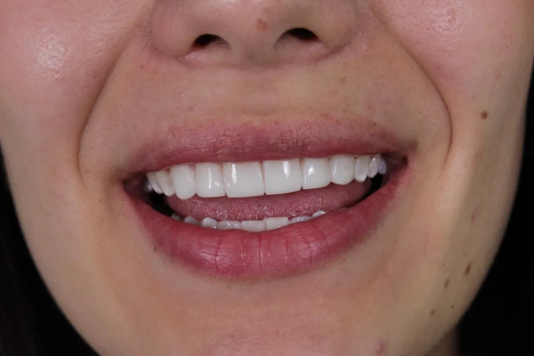 Veneers result on a real patient