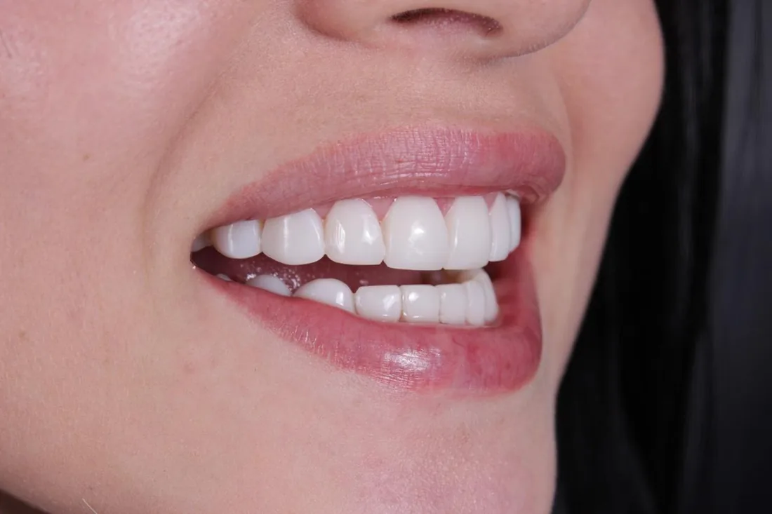 Real smile makeover result at Smile From Medellín