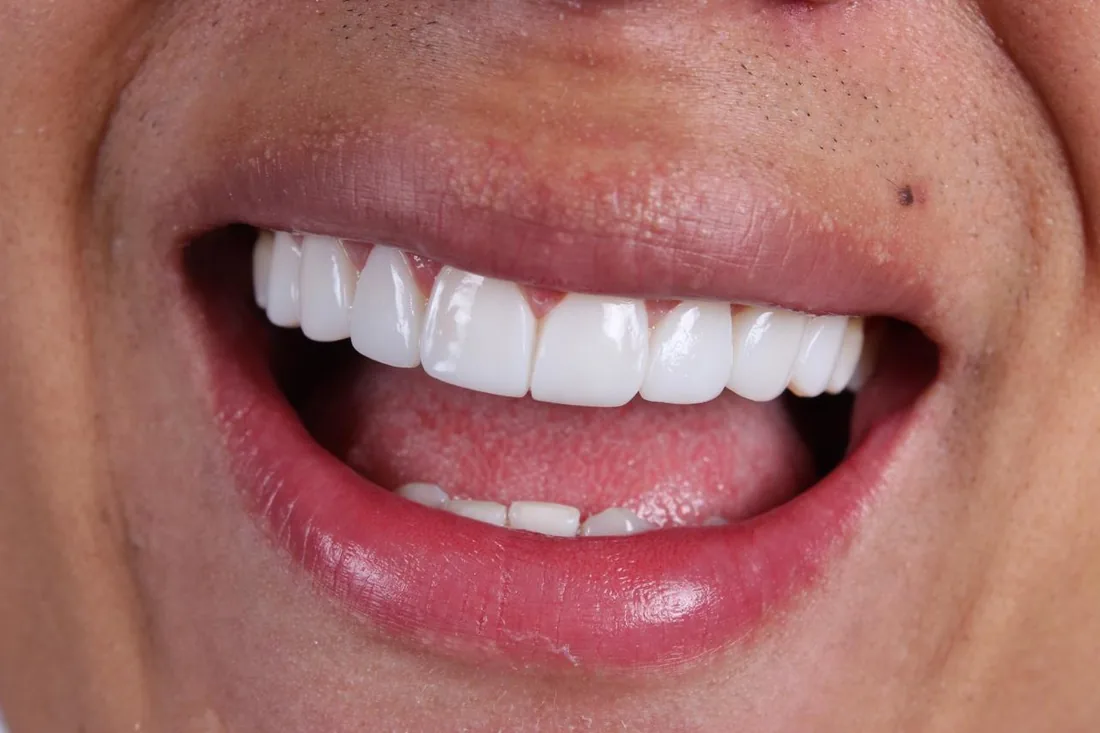 Resultado real de diseño de sonrisa