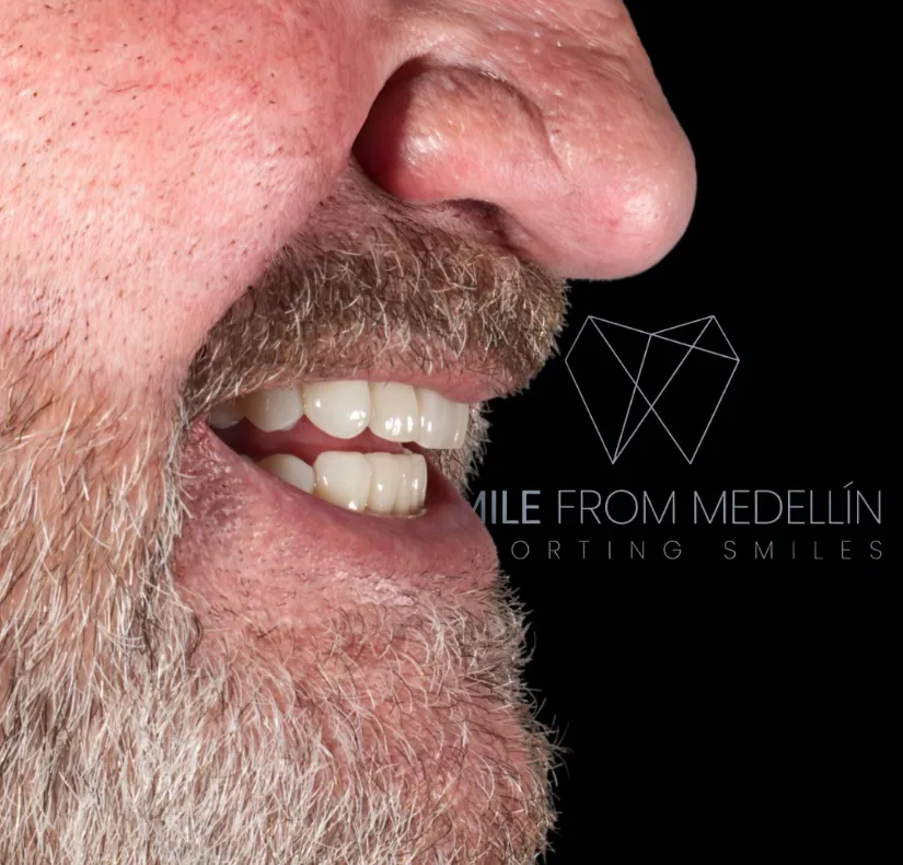 Smile after smile makeover, side view — Smile From Medellín