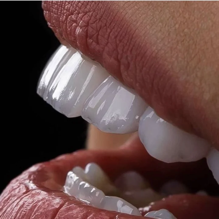 Smile with porcelain veneers by Smile From Medellín